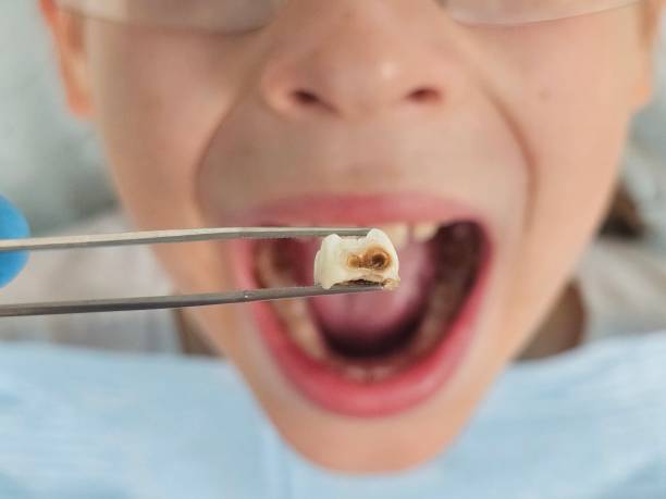 Best Broken or Chipped Tooth Repair in Rutherford, NJ